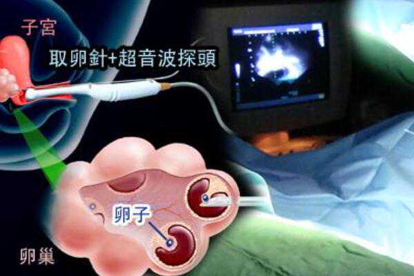 惠州代孕公司的费用,惠州人民医院第三代试管婴儿关于第三代试管婴儿你